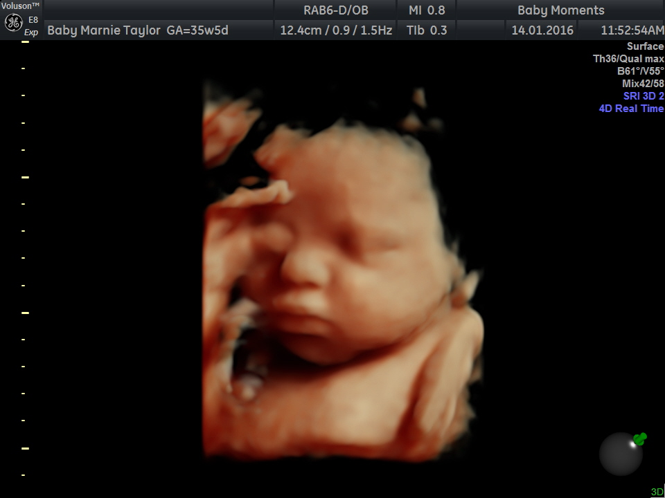 4 week pregnancy baby scan